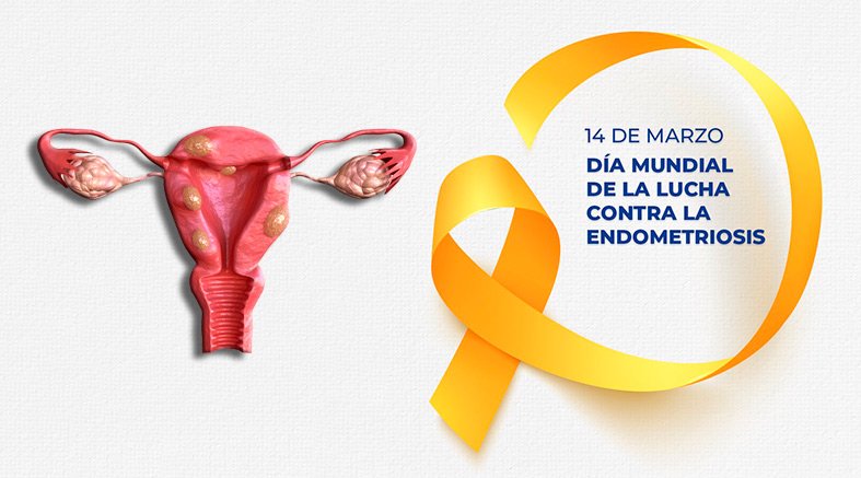 Endometriosis