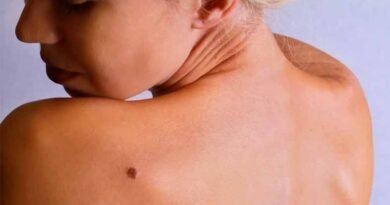 Melanoma