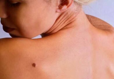Melanoma
