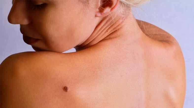 Melanoma